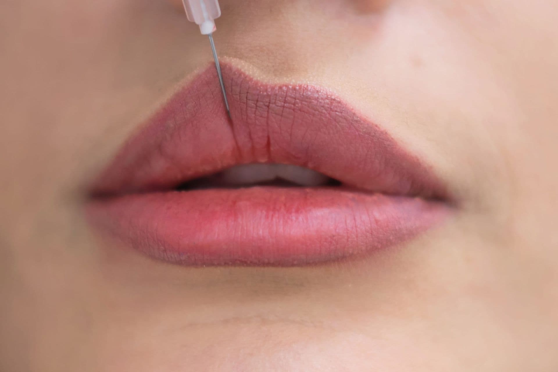 Close-up of a fine needle at the edge of a woman’s upper lip